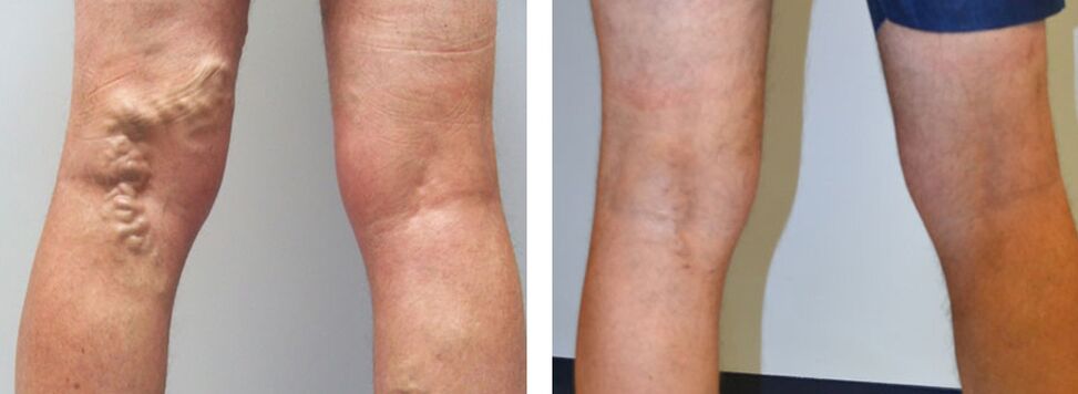 Foto antes e despois de usar Veniselle, a experiencia de usar crema