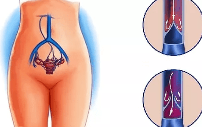 As razóns para o desenvolvemento de varices da pelve