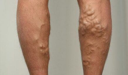 Síntomas de varices