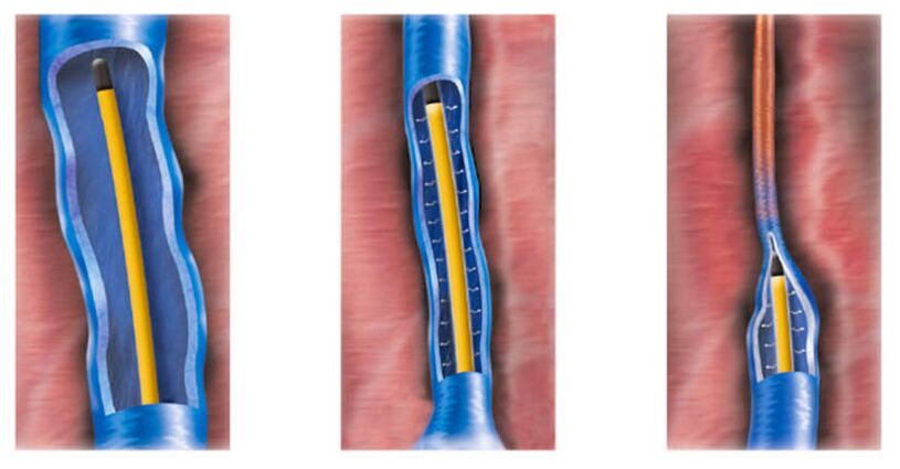 A ablación por radiofrecuencia como método para tratar varices