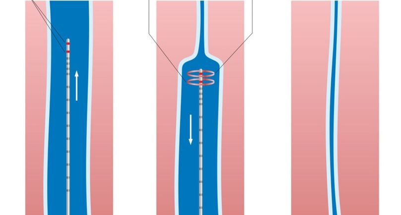 Tratamento con láser de varices nas pernas