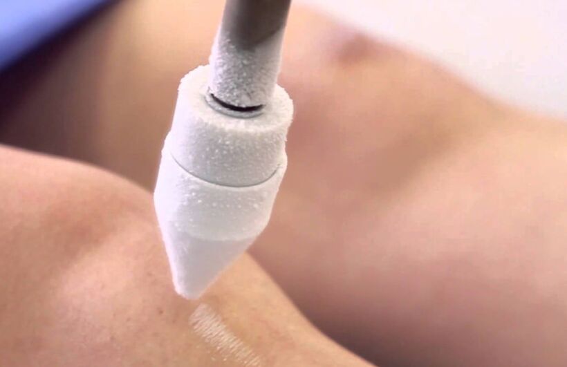 Tratamento de varices nas pernas con crioterapia